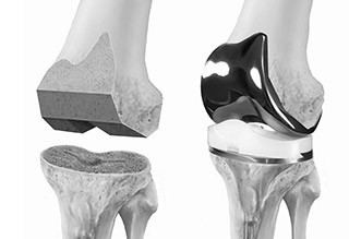 https://www.dhananjaygupta.com/wp-content/uploads/2015/11/best-knee-replacement-surgeon-dr-dhananjay-gupta-fortis-vasant-kunj-delhi-320x219.jpg