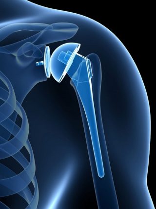 Shoulder-Replacement-Surgery-