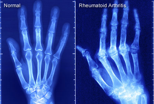 Rheumatoid-Arthritis.jpg