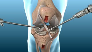 FAQ about ACL Reconstruction Surgery